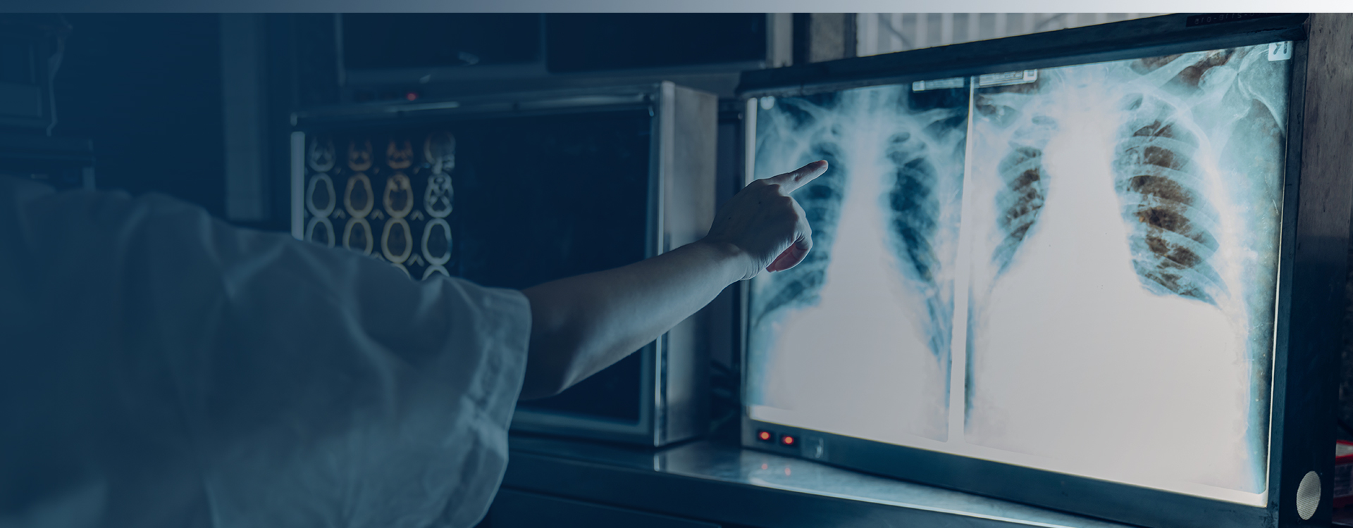 Incidental pulmonary nodules and lung cancer