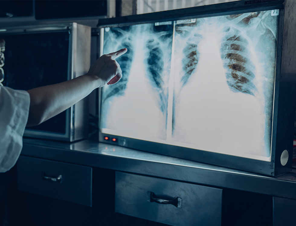 Incidental pulmonary nodules and lung cancer: your questions answered